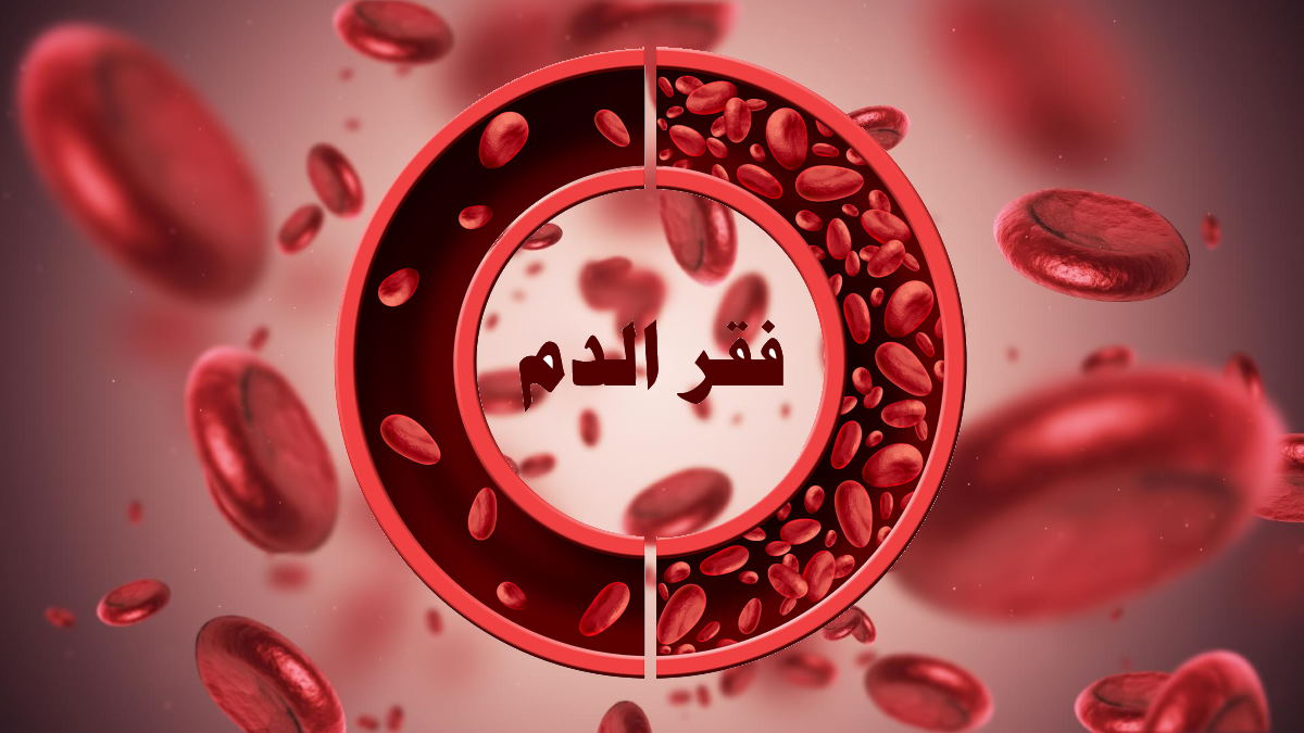 فقر الدم هو حالة نقص في حجم أو عدد كريات الدم الحمراء أو نقص في كمية هيموجلوبين الدم
